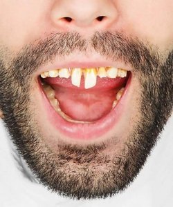 Sztuczne zęby - Neandertalczyk