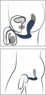 Vibrating Prostate Plug with C